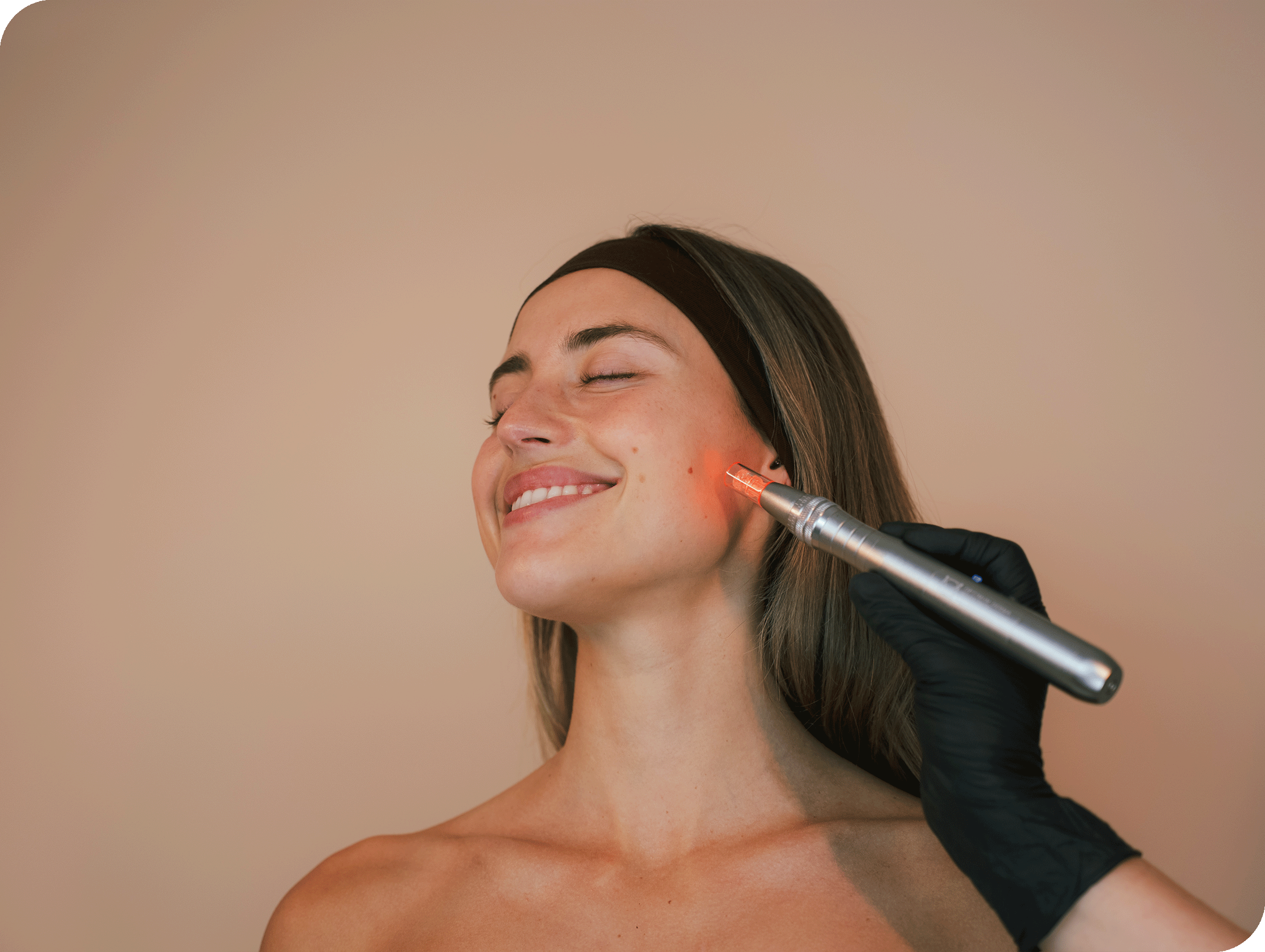 Microneedling treatment at SKIN Amsterdam