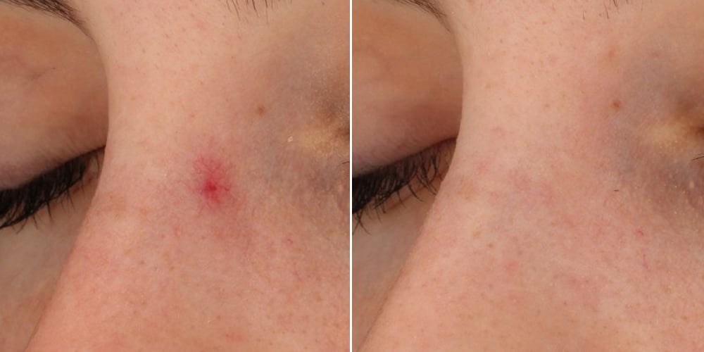 Before and after: redness treatment