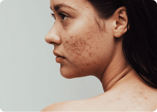 Volwassen Acne