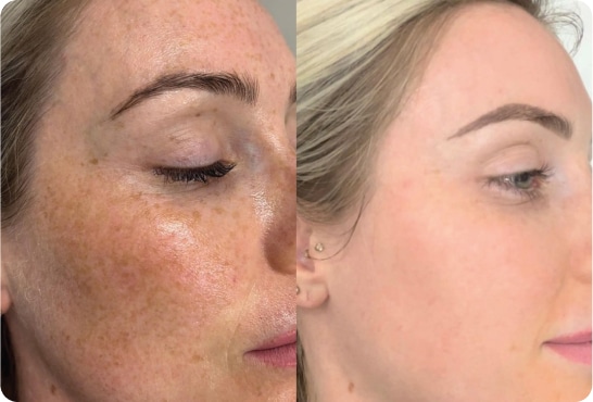 Before and after: pigmentation treatment