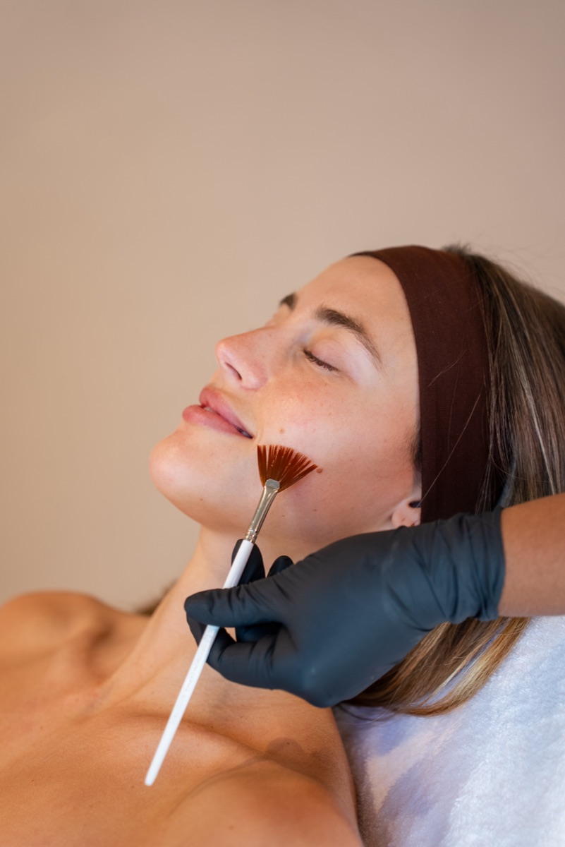 Chemical Peels